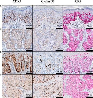 CDK4: A Novel Therapeutic Target for Extramammary Paget’s Disease